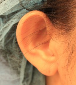 立ち耳の方へ 積極的な治療であなたの悩みが解消されます 新潟市で形成外科 美容外科 美容皮膚科をお探しなら やまもと形成外科