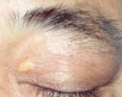 皮膚腫瘍　眼瞼黄色腫